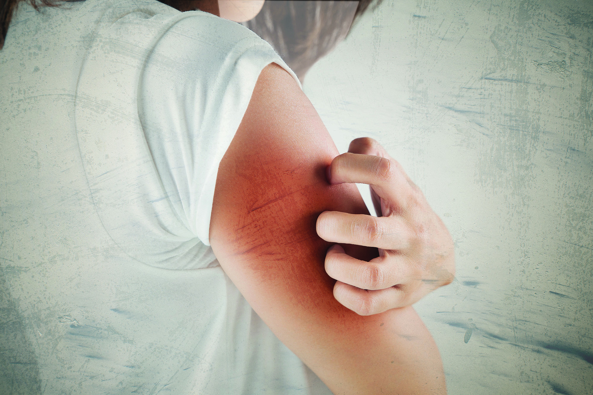 Woman scratching her arm